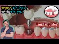 Implant life?/इम्प्लाण्ट कति टिक्छ?/Dental implant warranty/ Implant Price/ Doc Taj/Dentist in Nepal