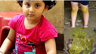 How to remove children knee \u0026 elbow darkness | বাচ্চাদের হাটু/ ঘাড়/ কনুইয়ের কালো দাগ দূর করার উপায়