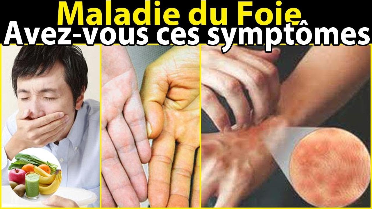 Les Symptômes De La Maladie Du Foie - YouTube