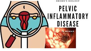 Pelvic inflammatory disease in Hindi | Symptoms, treatment in females