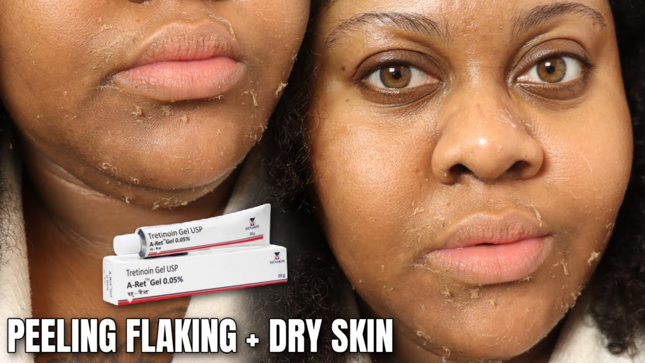 TRYING 1% TRETINOIN FOR 1 WEEK FOR DARK SPOTS + TEXTURE - YouTube