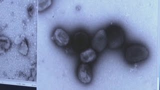 Bay Area prepares as monkeypox becomes global emergency