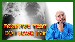 Tuberculosis (What The Positive Test Means)