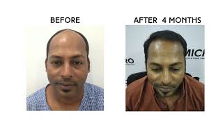 Micro Follicle Hair Transplant  | Latest Technology  | Now in Kerala