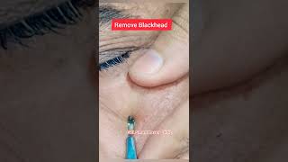 blackhead removal on face, #shorts #cyst #acnetreatment   #blackheads #pimplepopping #extractions