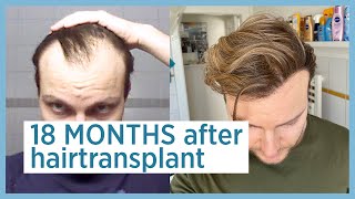 18 months after hairtransplant - Elithairtransplant Dr. Balwi Turkey (FINAL UPDATE)