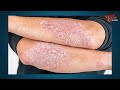 psoriasis ఆందోళన ఒత్తిడి ఎక్కువైతే ఈ వ్యాధి బారిన పడతారు dr. g. lakshmana rao teluguone health