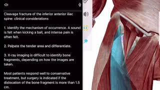 下前腸骨棘裂離骨折:臨床上の注意点 Cleavage fracture of the inferior anterior iliac spine: clinical considerations