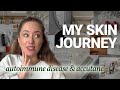 My honest Accutane journey!  Facing Acne and discovering I have Hashimoto’s