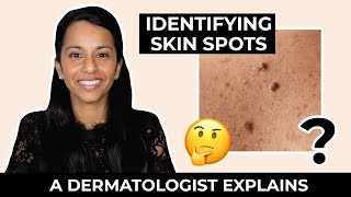Difference Between Moles, Skin Tags, Milia, Freckles and More!