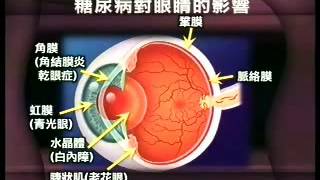 糖尿病對眼睛的影響