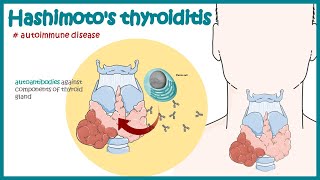 Hashimotos thyroiditis | Autoimmune diseases