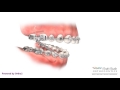 Forsus - Orthodontic Appliance