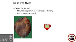 POCUS Cases 6: Pericardial Effusion