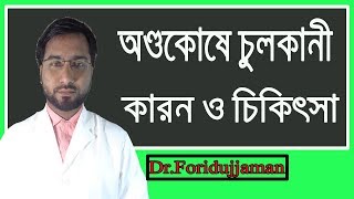 অণ্ডকোষে চুলকানী ও জ্বালাযন্ত্রণার চিকিৎসা ।Treatment of Scrotal Itching ।