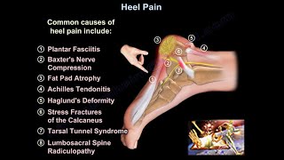 Heel Pain, causes and treatment, plantar fasciitis diagnosis and treatment.
