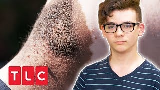 Riesiges Muttermal: Hat Vinnie Hautkrebs? | Dr. Pimple Popper | TLC Deutschland