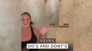 Spider Veins \u0026 Varicose Veins: Dos and Don'ts Explained!