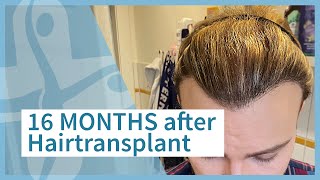 16 months after hairtransplant - Elithairtransplant Dr. Balwi Turkey