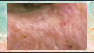 Creamy pimples \u0026 a few blackheads- Part 2