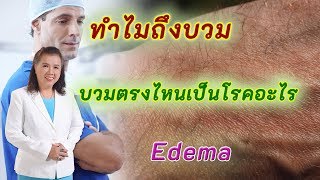 ทำไมถึงบวม บวมตรงไหนเป็นโรคอะไร | Edema | พี่ปลา Healthy Fish