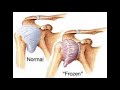 frozen shoulder උරහිස් සංධිය තද බව adhesive capsulitis how happens causes treatment sinhala prevent