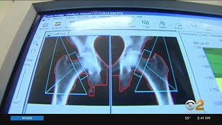 Bone Health A Growing Concern For Millions Of Older Women