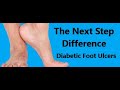 The Next Step Difference:  Diabetic Foot Ulcers