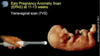 The 12 week scan: transabdominal and transvaginal ultrasound