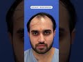 Hair Transplant Results | 4000 Grafts Hair Transplant | Medlinks #hairtransplantresults #shortsfeed