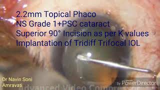 Tridiff IOL Implantation (No financial Interest)