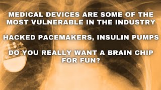 Hackers target medical devices: Do you really want a brain chip?