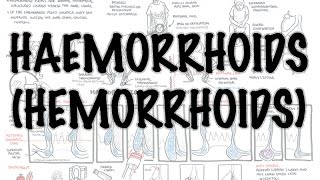 Haemorrhoids (Hemorrhoids) - Overview (pathophysiology, investigations and treatment)
