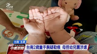 母控2歲童手腕勒痕為幼兒園施虐 台南市府已展開調查 20210217 公視中晝新聞