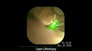 ERCP-Large CBD Stone with Laser Lithitripsy.