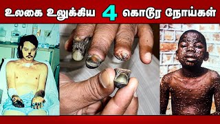 உலகை உலுக்கிய 4 கொடூரமான நோய்கள்.! 4 Deadly Disesases in the World.! Crazy Talk