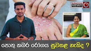 පොතු කබර රෝගය සුව කළ හැකිද...? - ඩොක්ටගෙන් අහන්න…(2023-01-15)vitiligo psoriasis psoriasis sri lanka