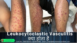 Leukocytoclastic Vasculitis / sudden red rashes / red spot on leg/ palpable purp