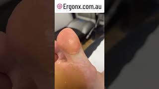 Big toe hard skin (callus) cutting in podiatry clinic can be soooo satisfying to watch