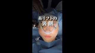 【糸リフトの裏側💥】アプリの様なフェイスラインに💖#short #小顔整形 #顔痩せ