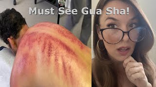 *GUA SHA* Compilation! WOW! Scraping, Kerokan, For Over 25 Minutes! *ASMR*