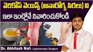 వెరికోస్ వెయిన్స్ ఇంటి చిట్కా | Varicose Veins Home Remedies | Spider Veins Symtpoms | Dr Abhilash