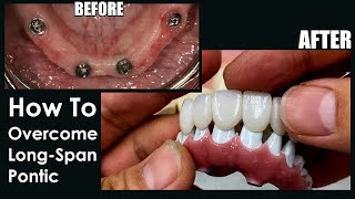 How to Overcome Long-Span Pontic with a 7-Star Restoration