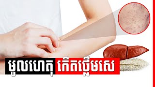 ជំងឺរលាកថ្លើមប្រភេទ C , Hepatitis C