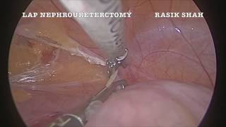 lap nephro-ureterectomy edited: Rasik Shah