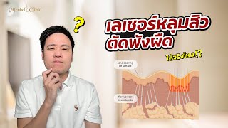 เลเซอร์หลุมสิว ตัดพังผืดได้จริงมั้ย!?