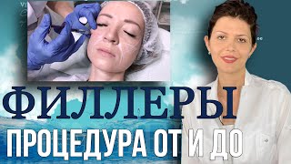 ФИЛЛЕРЫ: Процедура ОТ и ДО | Больно ли делать Филлер? | ОТЗЫВ о Филлере