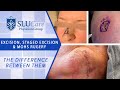 The Difference Between Excision, Staged Excision & Mohs Surgery for removing skin cancer