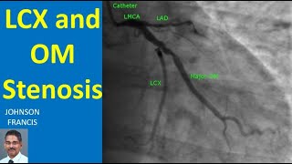 LCX and OM Stenosis