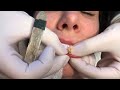 removing illegal lip fillers